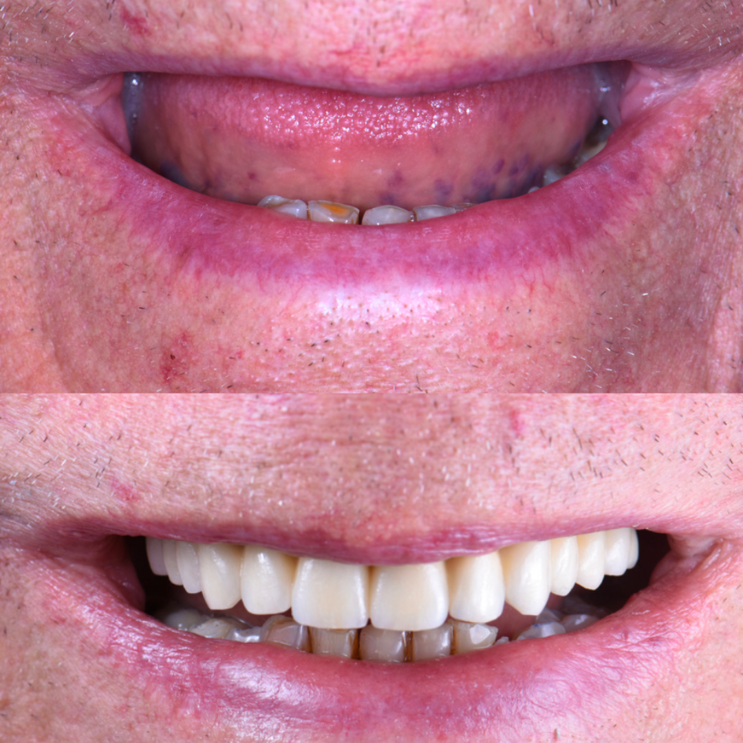 Imagen comparativa del antes y después de un tratamiento dental, mostrando la mejora en la apariencia de los dientes de una persona.